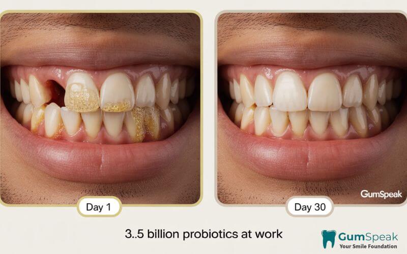 ProDentim results before and after 30 days showing improvement in gum inflammation and teeth brightness.