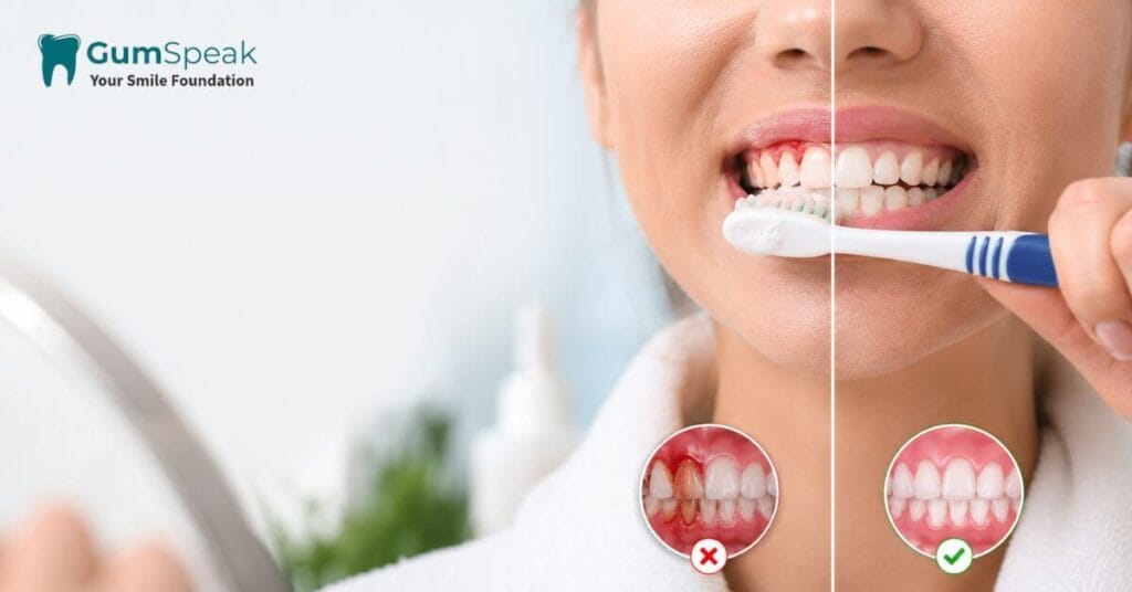 Bleeding Gums Causes, Treatments & How to Stop It Fast